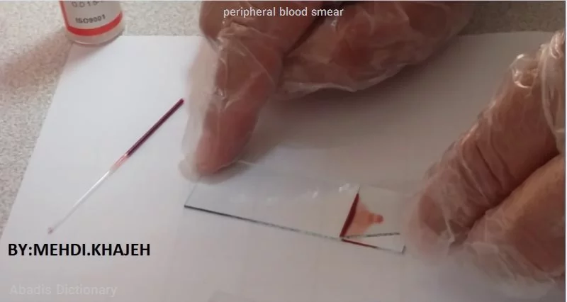 peripheral blood smear